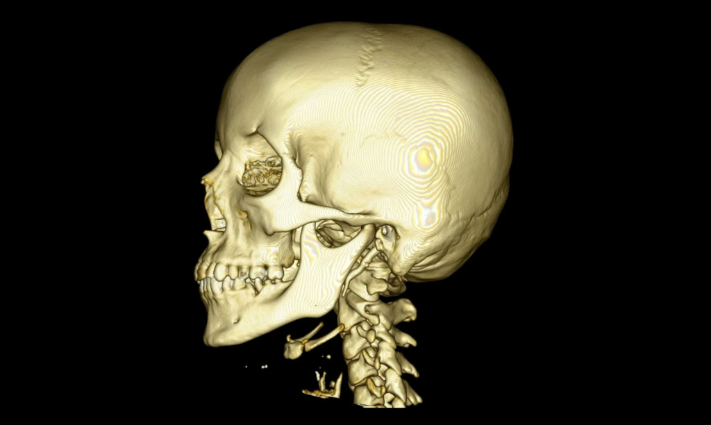 Программа на основе искусственного интеллекта позволит создать эскиз имплантата по снимку компьютерной томографии черепа