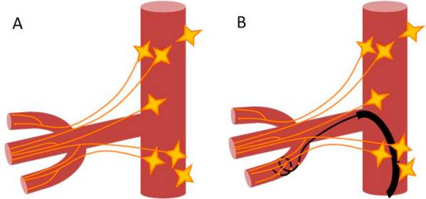 А: фактическая анатомия почечного нервного сплетения. В: анатомически оптимизированная дистальная денервация почки