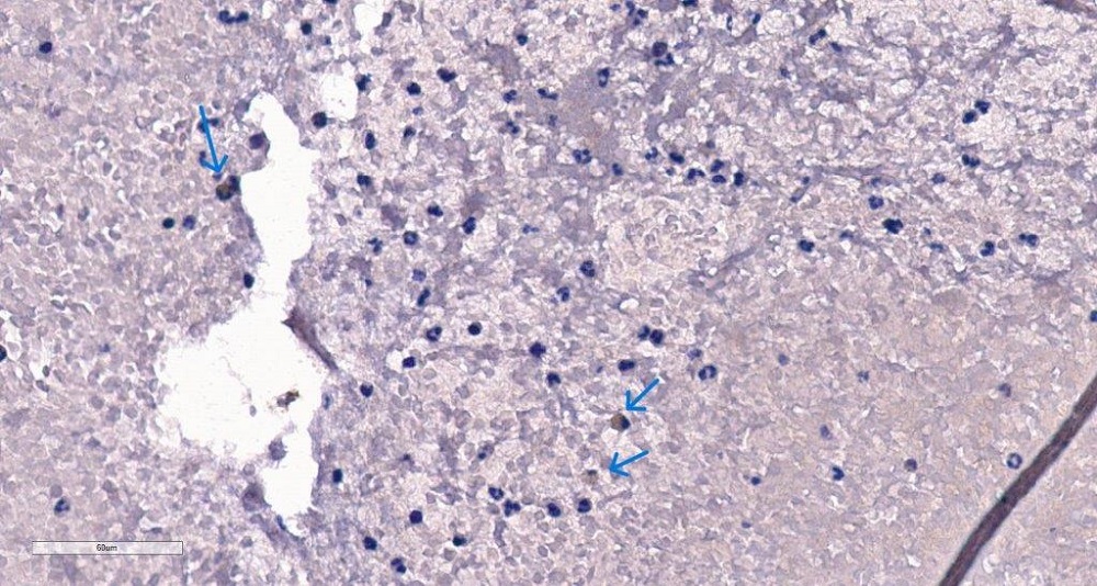 Фрагмент тромба. Экспрессия NLRP3 инфламмасомы в нейтрофилах и макрофагах (синие стрелки), увеличение х400