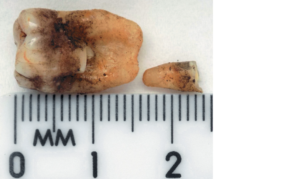 Общий вид зуба индивида AB147 с фрагментом, выбранным для исследования