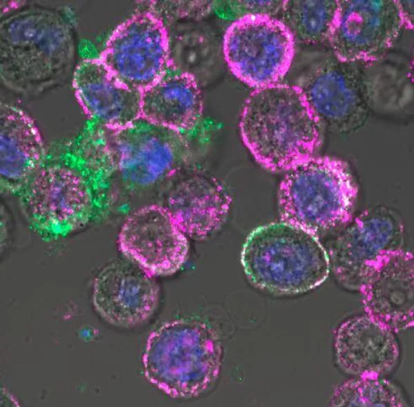© City of Hope / Одно из применений онколитического вируса. Проникнув в раковые клетки, он заставляет их активнее вырабатывать белок CD19 (пурпурного цвета), который служит мишенью для иммунотерапии рака