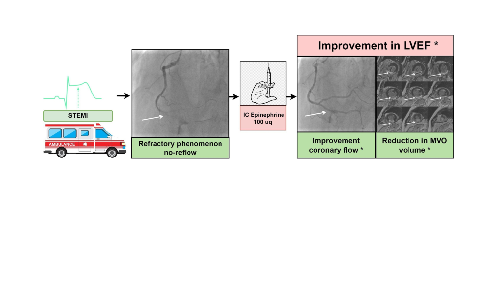 Новый метод лечения рефрактерного феномена No-reflow у пациентов с инфарктом миокарда