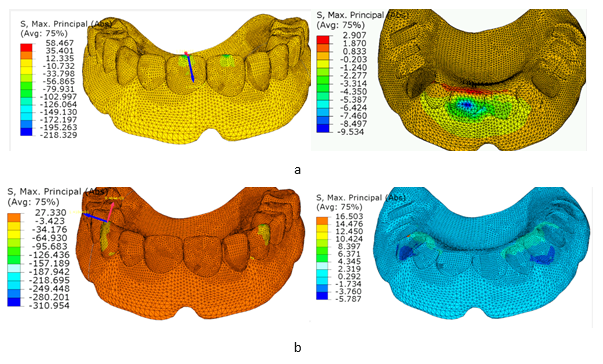 Распределение напряжений в базисе зубного протеза из ПЭТ, а также в зубах, на этапе образования трещин при симметричном нагружении резцов 11 (а) и клыков 33 (б)