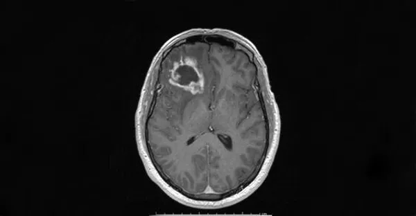 © Gerard Toussaint, Texas A&M Health Science Center / Опухоль мозга (глиобластома) на МРТ